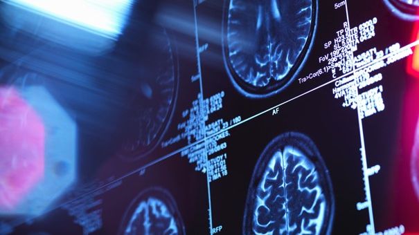Ny metod identifierar mutationer bakom elakartad hjärntumör hos barn