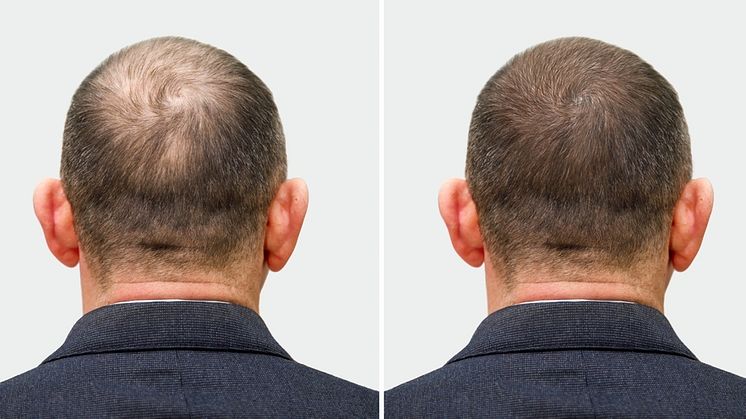 Desoxyribose Wundermittel gegen Haarausfall