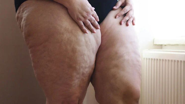 Lipedema, obesity or normal fat legs? What do lipedema legs look like in Singaporeans?