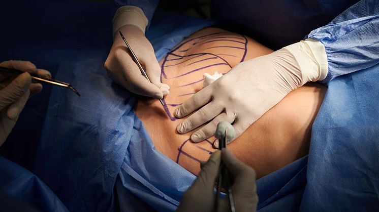 Benefits and side effects of liposuction