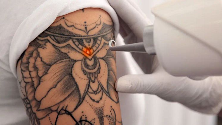 Tattoo Removal FAQs: Doctor Answers from Singapore Podcast