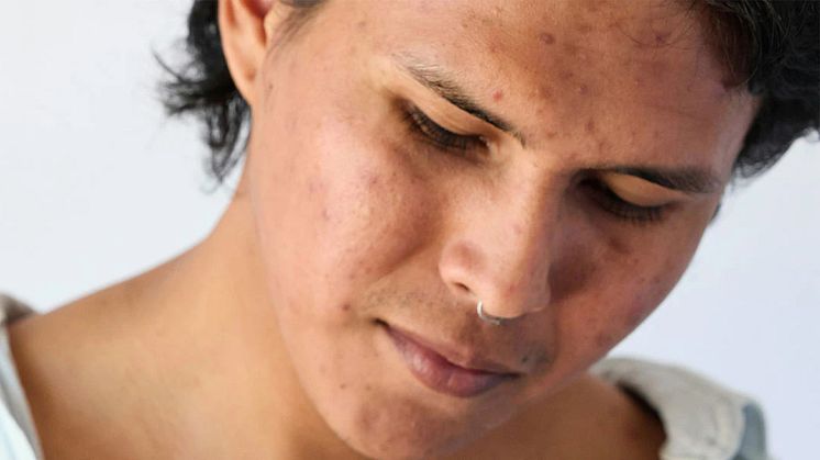 Pico Fractional Laser Removes Hyperpigmentation in Asian Skin For Good