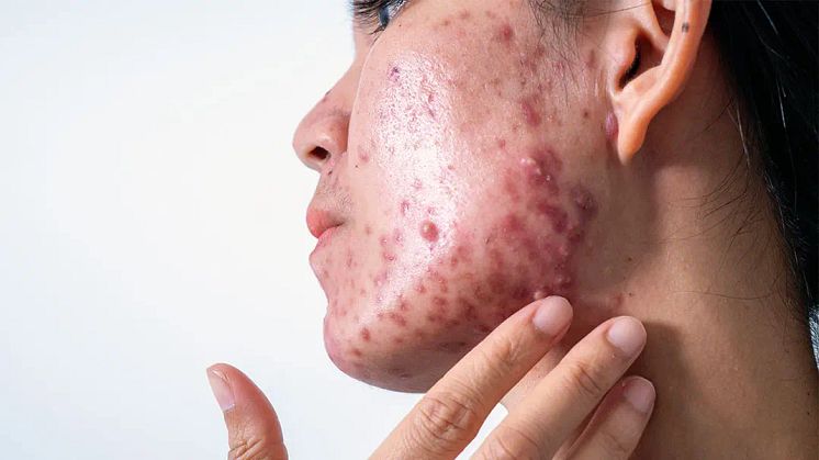 How to identify your acne type, Occurrence of Acne in Singapore