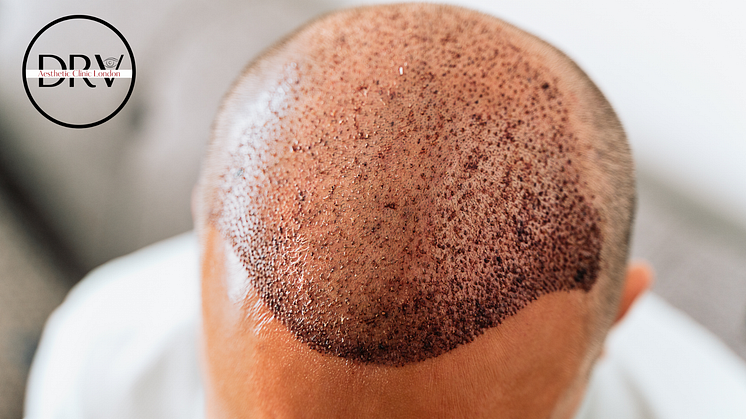 Londoners Reclaiming Confidence One Graft at a Time: DRV Clinic Sets New Standard in FUE Hair Transplant Results