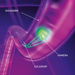 Darmspiegelung