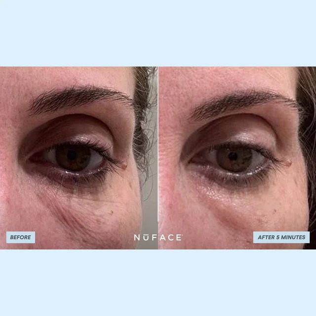 Ionplex ® Hydra-Gel Power Patches 