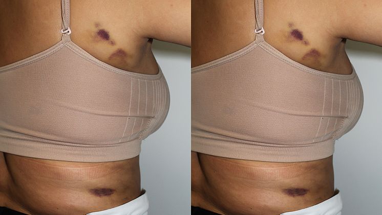 One Wrong Move And The Entire Contour Is Wrong - Cases of liposuction gone wrong.jpg
