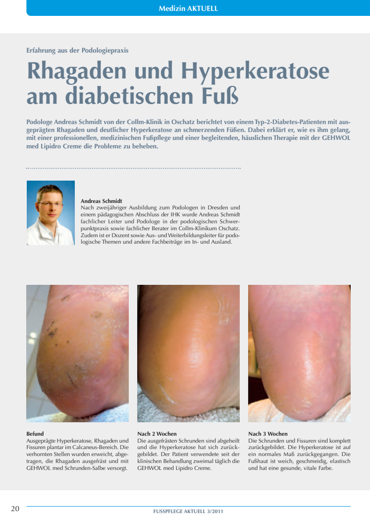 Erfahrung aus der Podologiepraxis: Rhagaden und Hyperkeratose am diabetischen Fuß