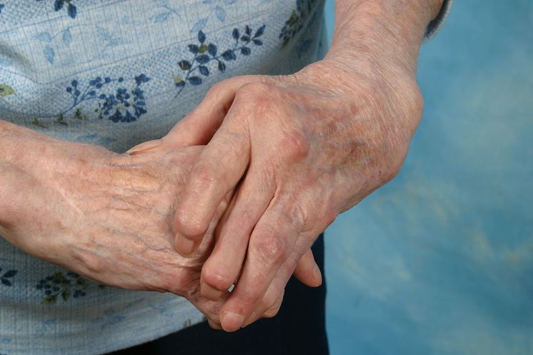Felställningar i händer vid reumatoid artrit 