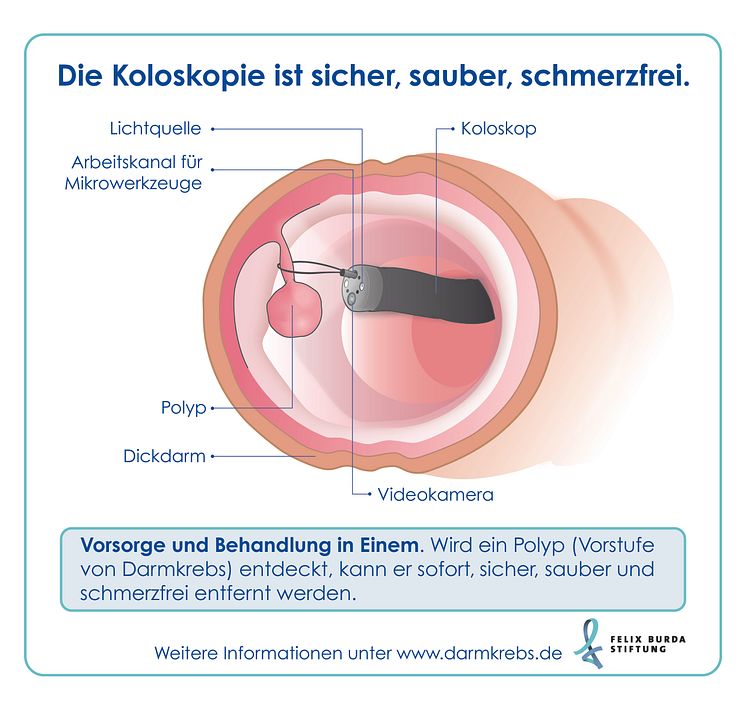 Nur bei der Darmspiegelung können Vorstufen von Darmkrebs entdeckt und gleich entfernt werden. 