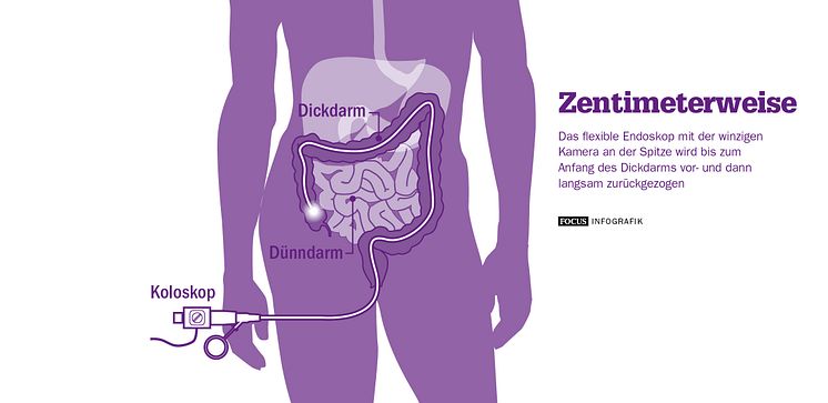 Zentimeterweise: Das Endoskop. FOCUS Infografik