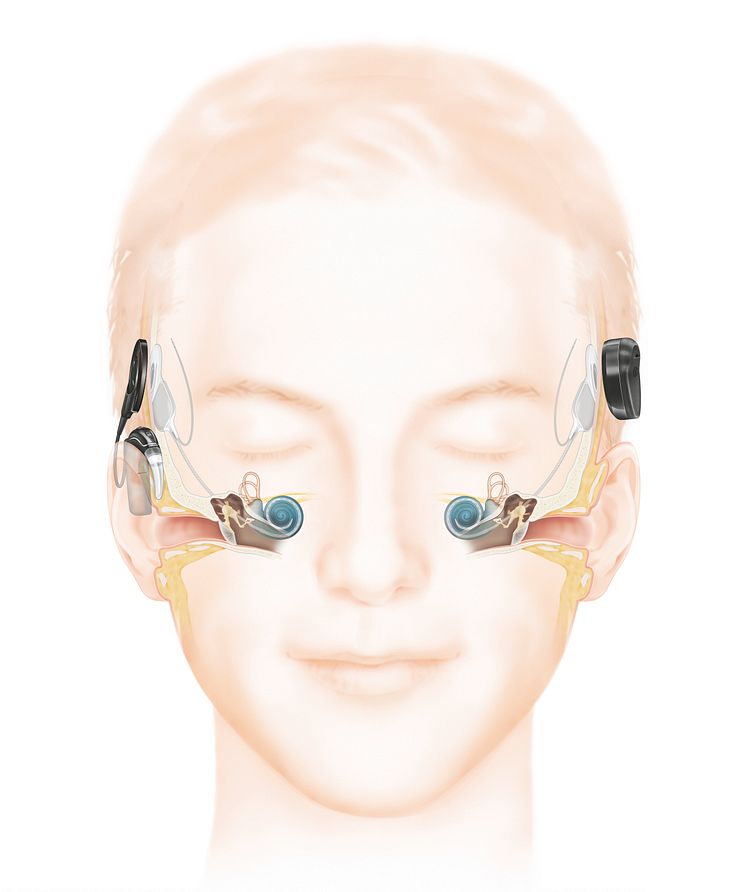 Wie das Hören mit einem Cochlea-Implantat funktioniert