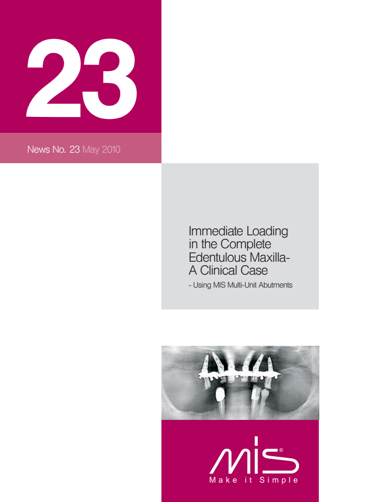 Immediate Loading in the Complete Edentolous Maxilla, A Clinical Case