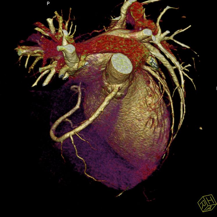 Hjärtat (datortomografi)