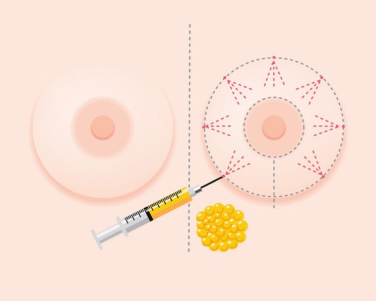 6194464ec2b99c9991dba019_fat grafting treatment singapore
