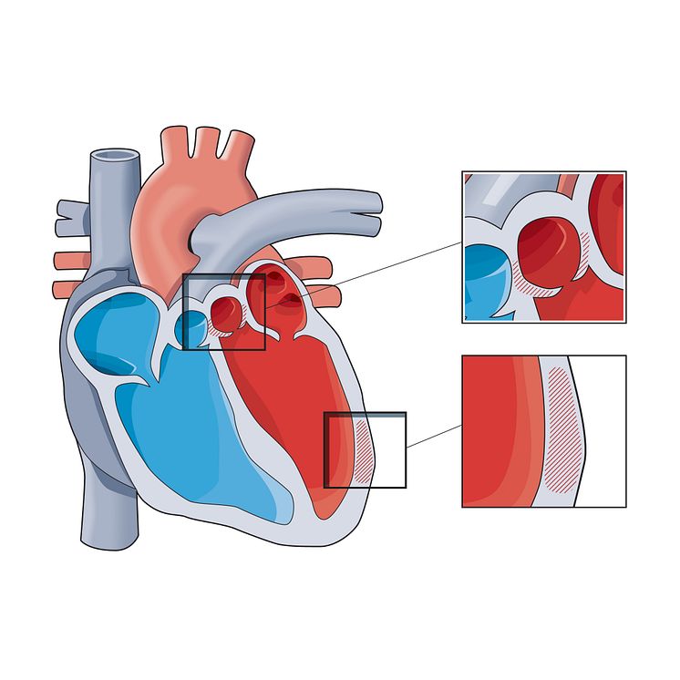 Hjärtsvikt illustration Kjell Thorsson