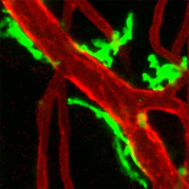 Accumulation of macrophages