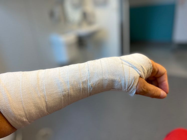 Brukket arm