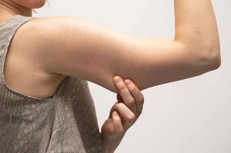 bingo-wings-armpit-fat-accessory-breasts-why-they-wont-respond-to-non-invasive-treatments