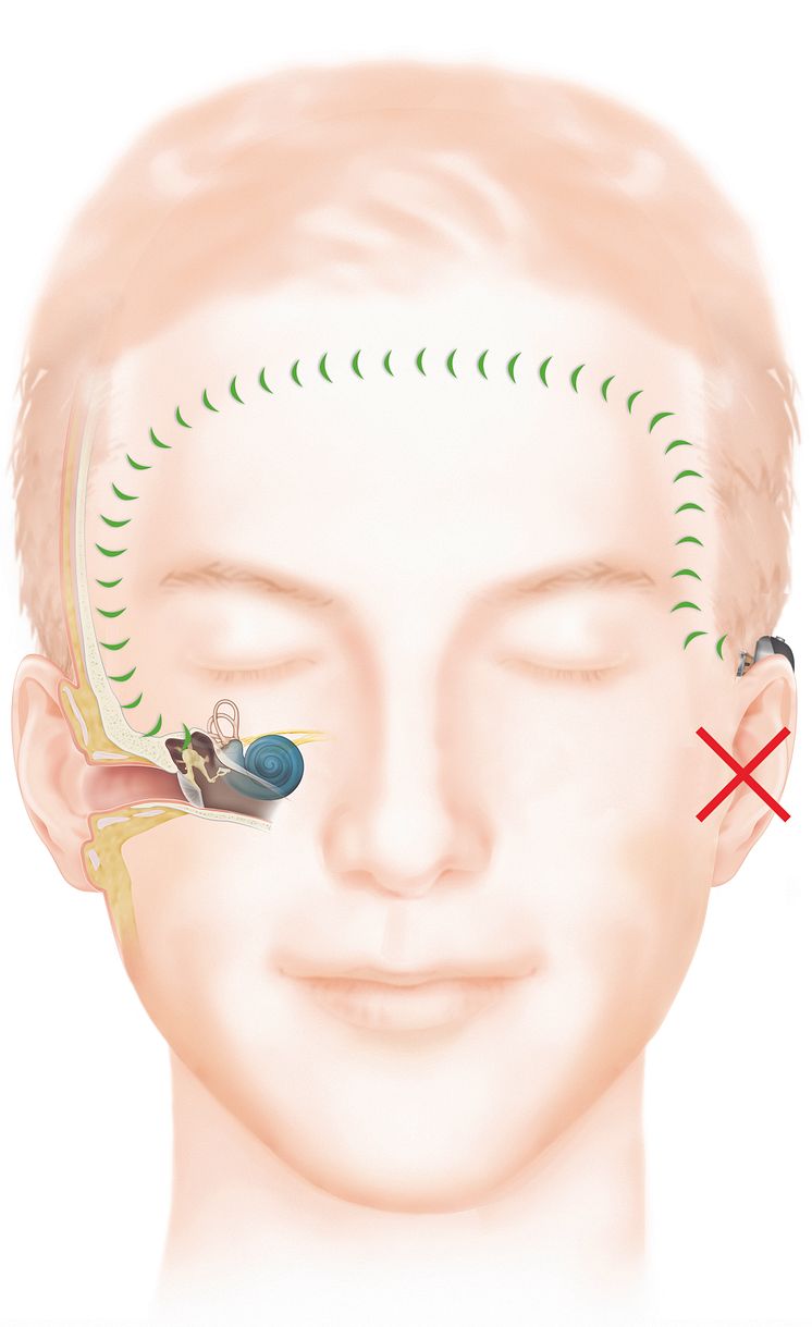 Wie das Hören mit einem Baha Knochenleitungsimplantat bei einseitigem Hörverlust funktioniert