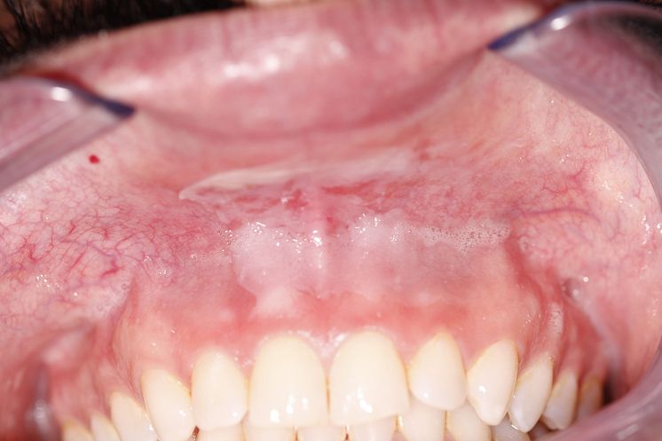 Bild 2a tandläkare med grad 4 av 4 snuslesion innan Stingfree test