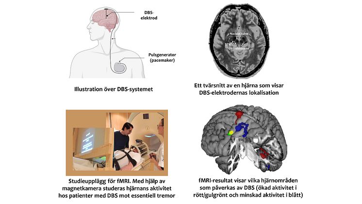 DBS, djup hjärnstimulering