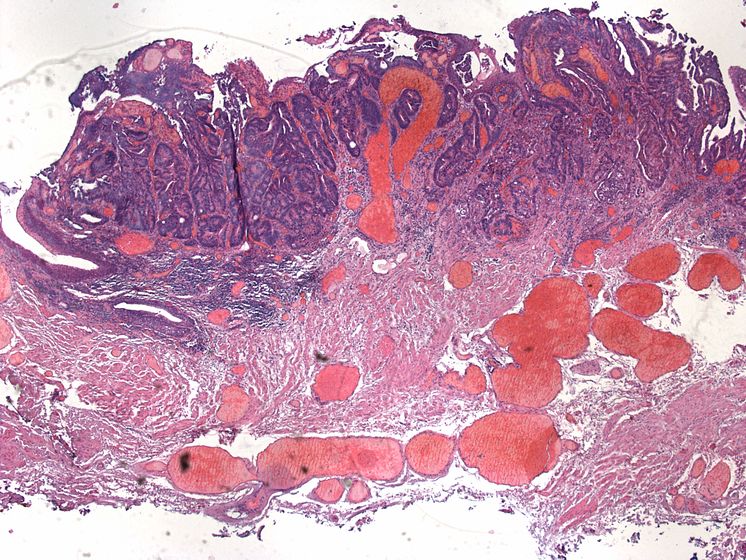 Rektumkarzinom - Malignitätsgrad 1 (histologisches Foto)