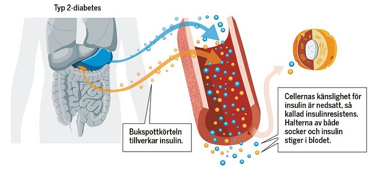 Det här händer i kroppen vid typ 2-diabetes