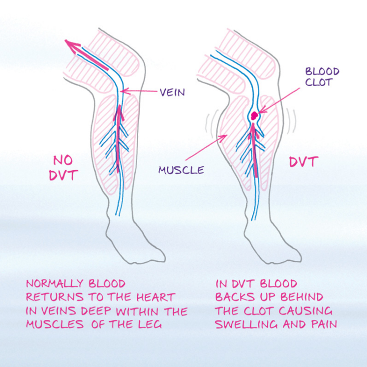 DVT, blodpropp i benet. Illustration