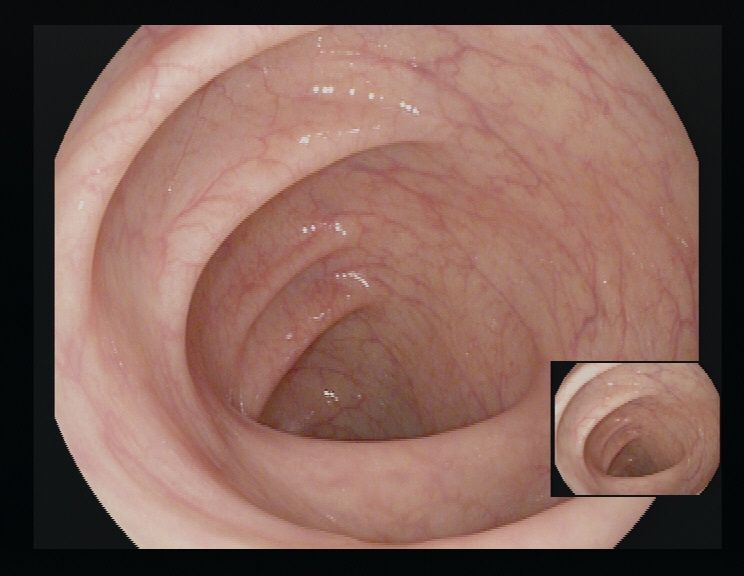 Innenansicht eines sauber gespülten Darms während der Koloskopie.