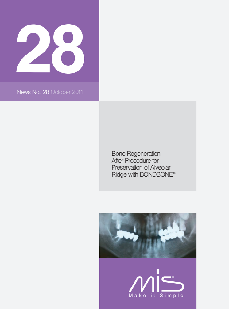 Bone Regeneration After Procedure For Preservation of Alveolar Ridge With BONDBONE®