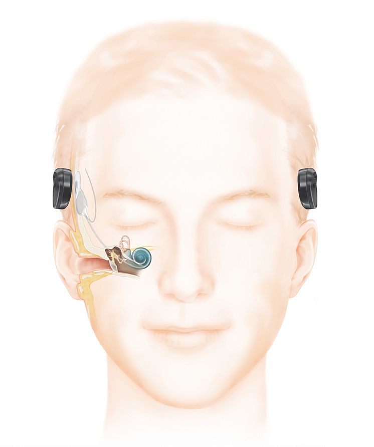 Wie das Hören mit einem Cochlea-Implantat (frei vom Ohr) funktioniert