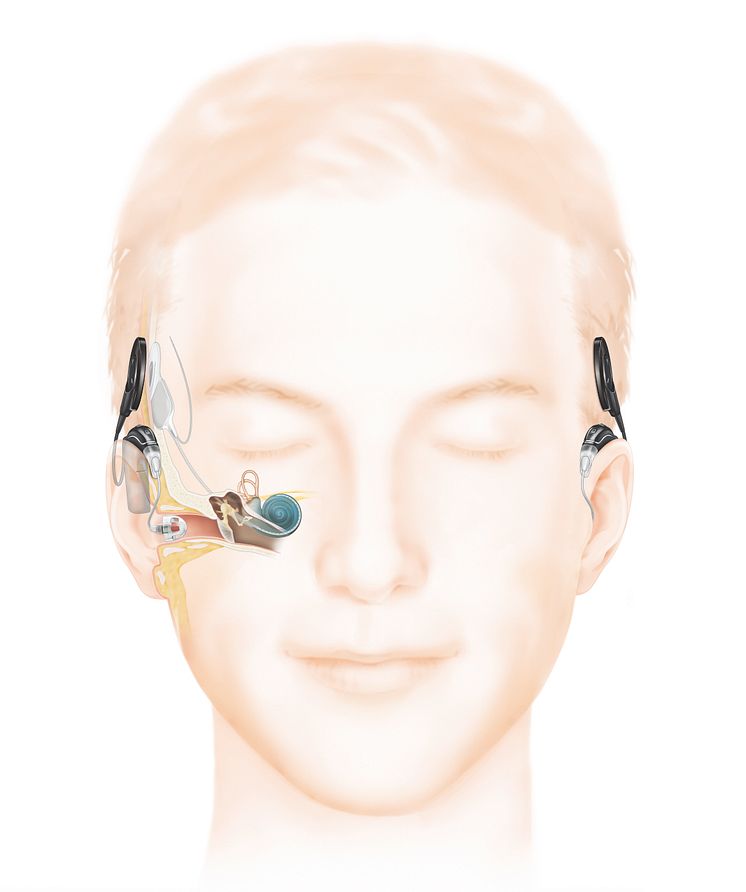 Wie das Hören mit einem Cochlea-Implantat mit Akustikkomponente funktioniert