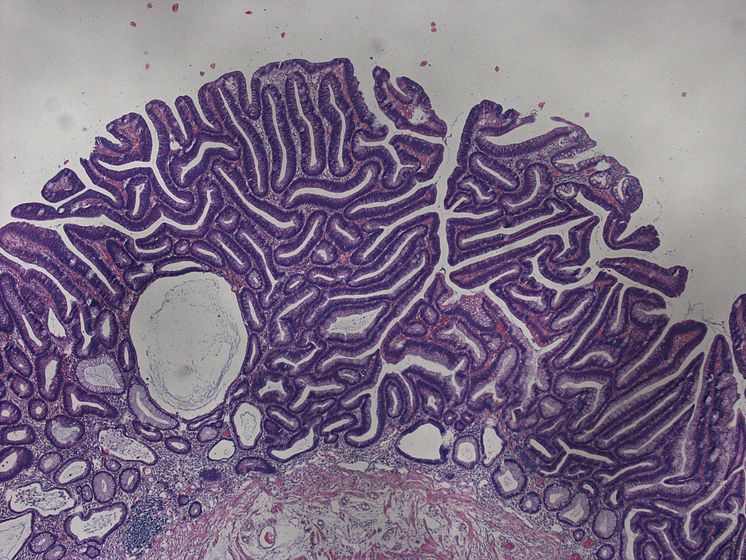 Tubuläres Adenom des Kolon (histologisches Foto)