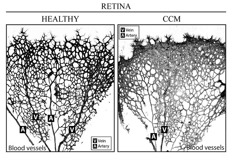 CCM retina