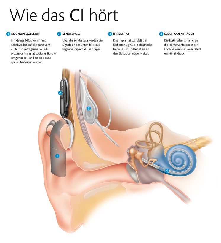 Wie das Hören mit einem Cochlea-Implantat funktioniert