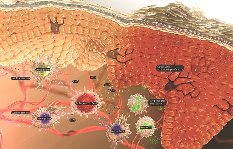 Image_IL-23 in the pathogenesis of psoriasis