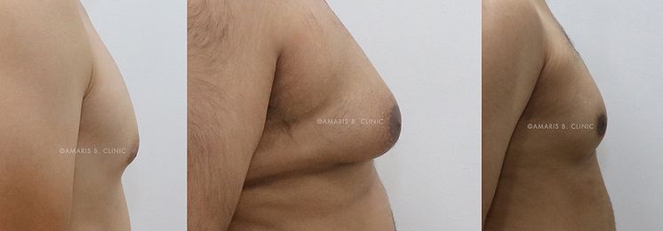 61109edcb80d6e34f7f5cc1b_5e9e76c169e4ff2ab8a45876_Header-Gynecomastia or Pseudogynecomastia