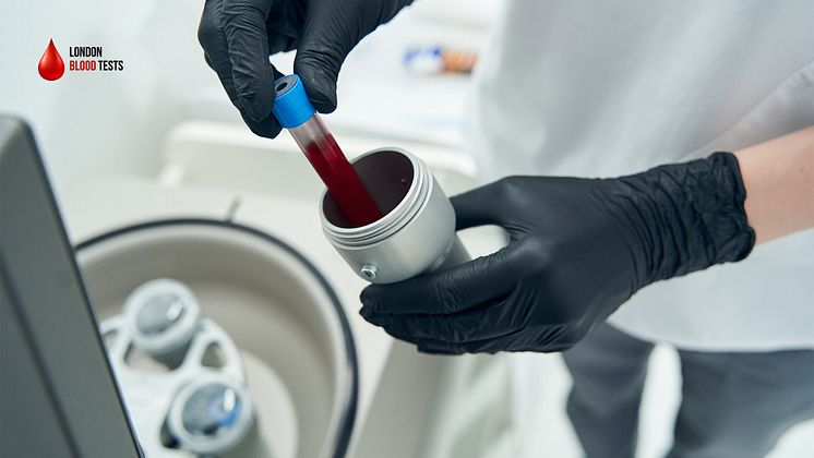 london-blood-tests-d-dimer-testing.jpg
