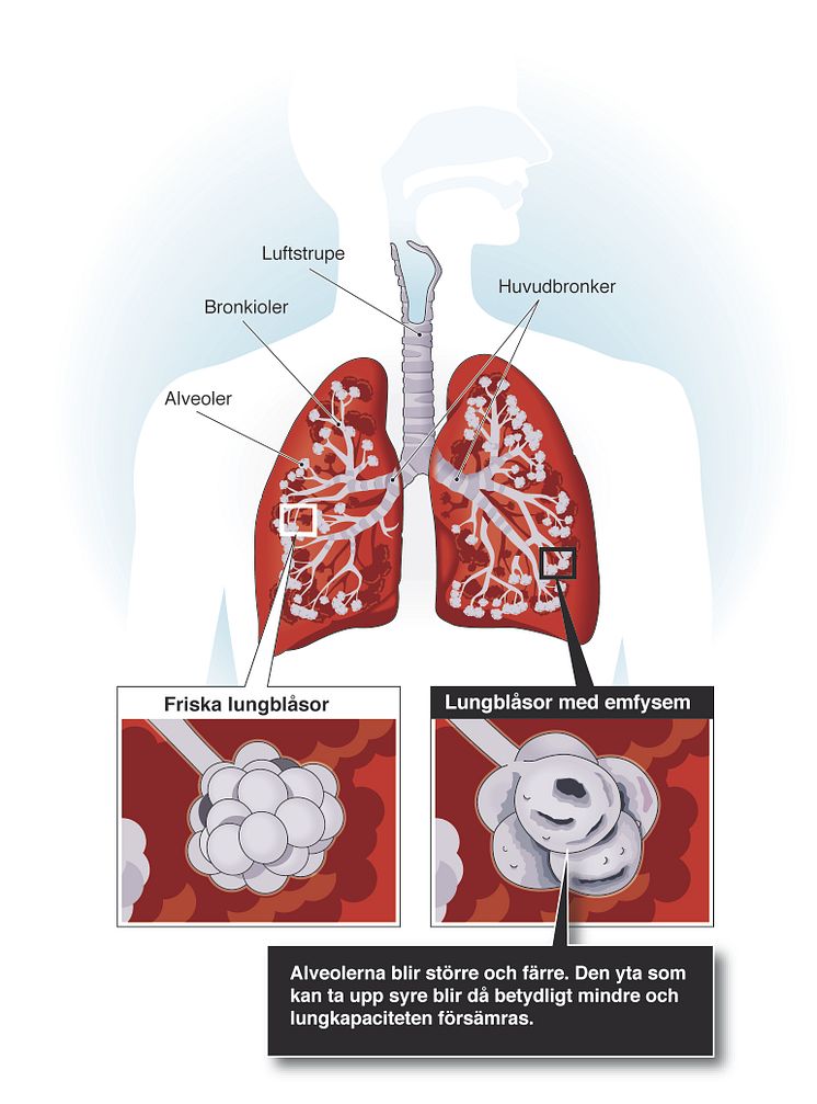 Lungor angripna av KOL