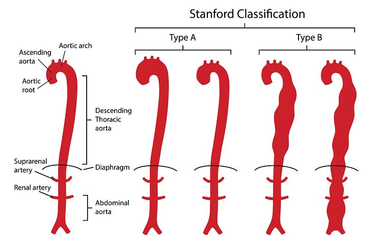 AdobeStock_Gesunde-Aorta-im-Vergleich-mit-Aortendissektion-Typ-A-und-B_Stanford-Klassifikation