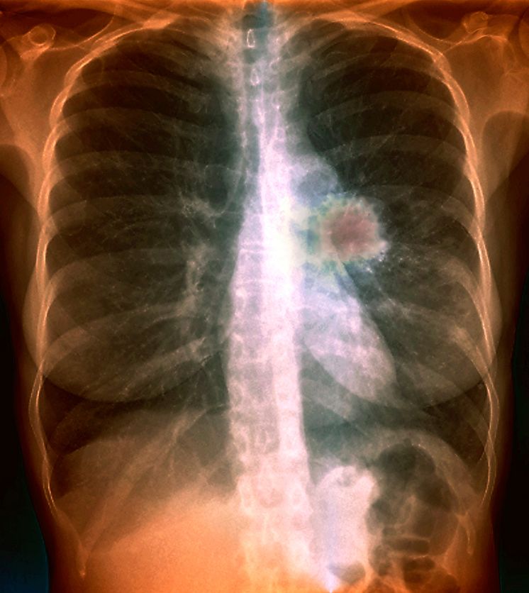 X-ray showing lungcancer