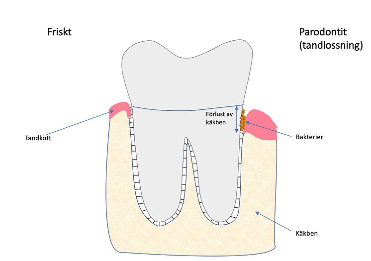 Parodontit