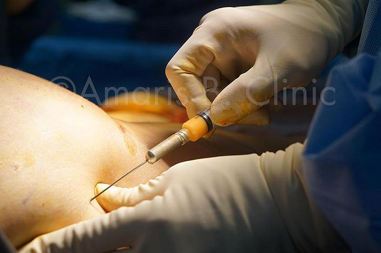 60c4ae7c934a5c2c63364c49_Dr-Ivan-Puah-Fat-Grafting-Amaris-B-Clinic.jpg
