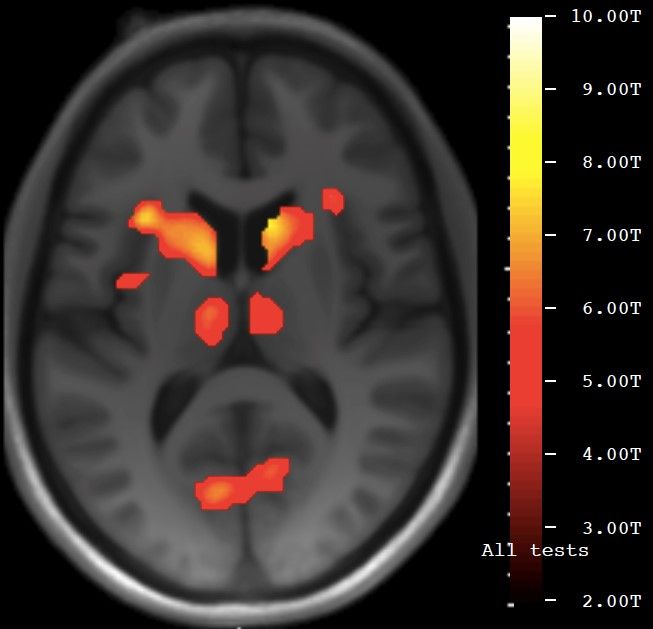 fMRI-bild av hjärna