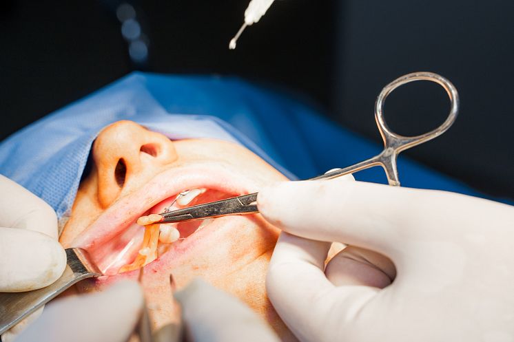 buccal fat surgery