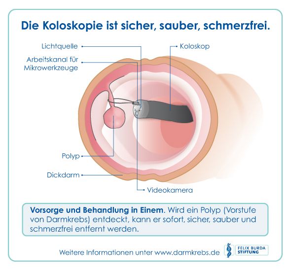 Darmkrebsvorsorge mittels Darmspiegelung