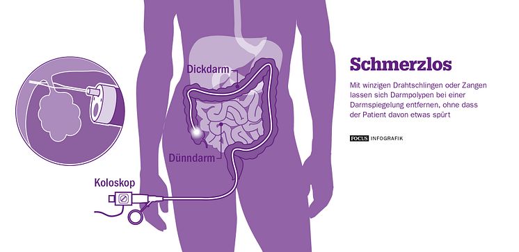 Darmspiegelung: Schmerzloses Entfernen von Polypen