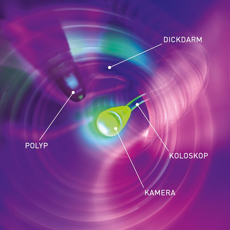 Polyp Darmspiegelung/Koloskopie. BESCHRIFTET
