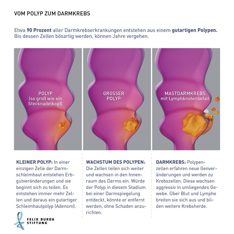 Grafische Darstellung des Wachstums vom Polyp zum Darmkrebs